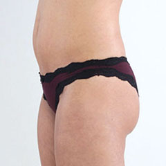Liposuction of abdomen and love handles, Agnes, 1 day after 