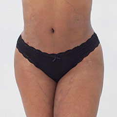 Brazlian Butt Lift for Ashley