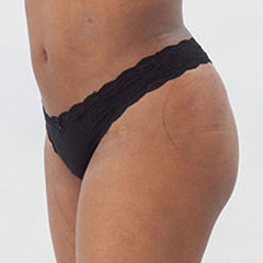 Brazlian Butt Lift for Ashley, side view 