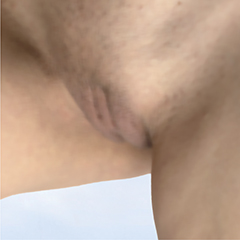 Labiaplasty and Fat Transfer to Labia Majora
