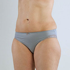 Liopsuction for thighs and waist, Lena, 1 day after