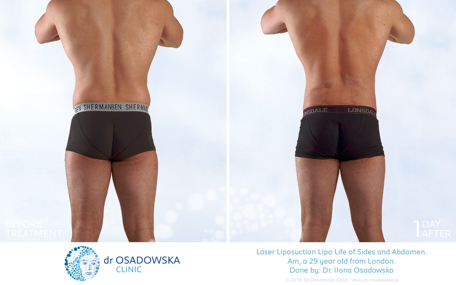 Liposuction abdomen flanks, LipoLife, before after, 3 months, back view