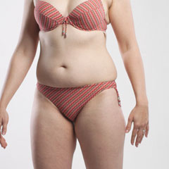 Liposuction LipoLife for abdomen, sides and thighs