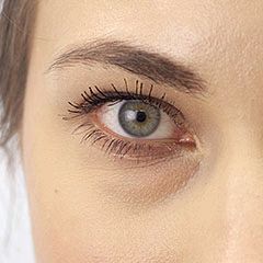 Lower eyelid transconjunctival surgery, Martha, 7 days after