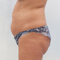 Liposuction of abdomen and waist, Margaret, 5 weeks after