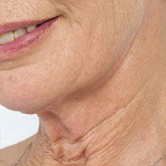 Neck and jawls - Thread Lift, Aptos