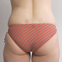Liposuction for inner thighs and waist