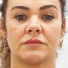 Thread Lift for middle face