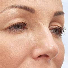 Upper eyelid laser surgery, before and 5 weeks after