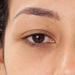 Upper eyelid laser surgery, before and 6 months after